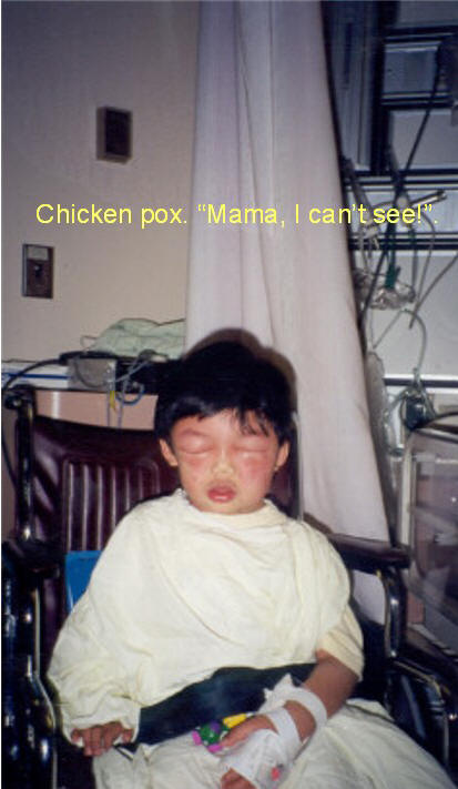 chicken pox, i can't see mama